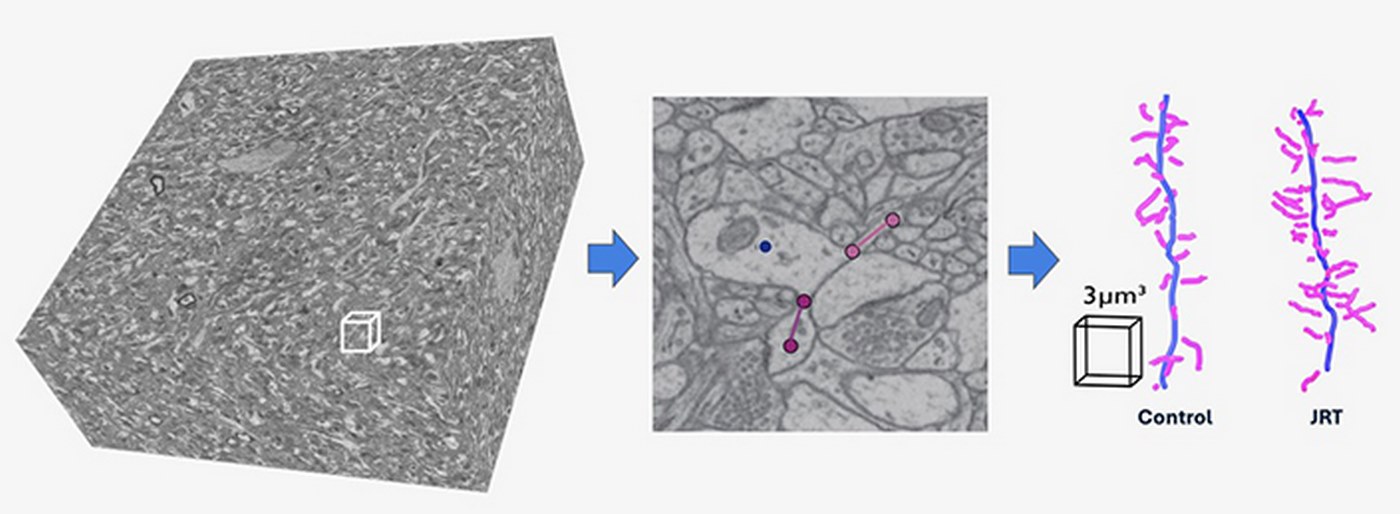 LSD Tweaked to Harness Therapeutic Power for Mental Health Without Hallucinogenic Effects