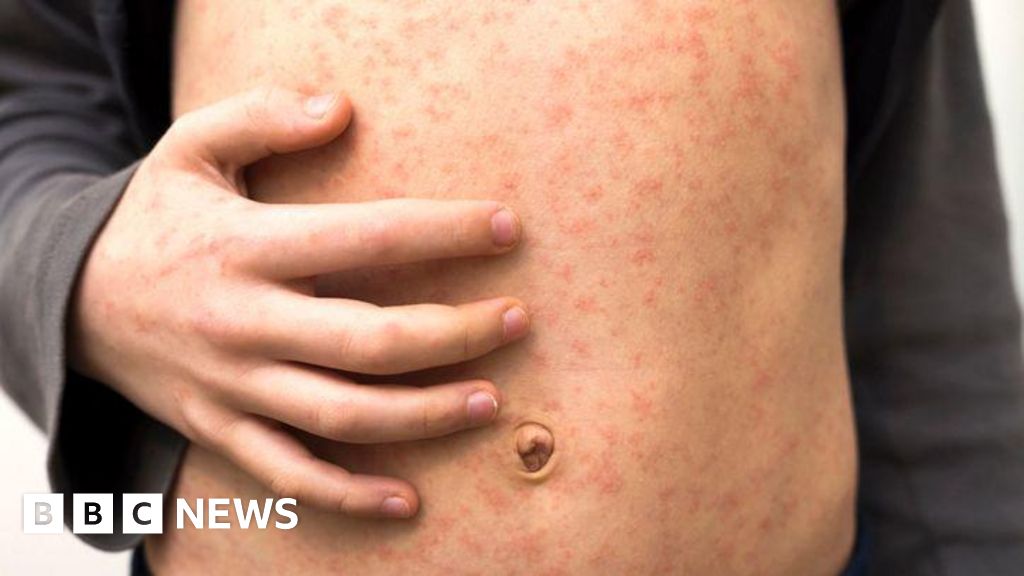 Measles warning to holidaymakers as cases rise across Europe