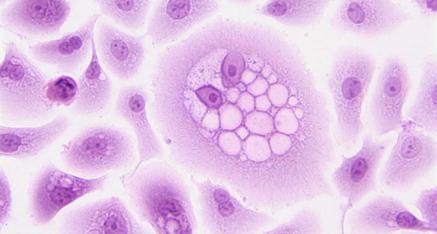 Targeting an Enzyme Could Rewire Cancer Cells to Suppress Growth by up to 77% for Melanoma and Colorectal Tumors