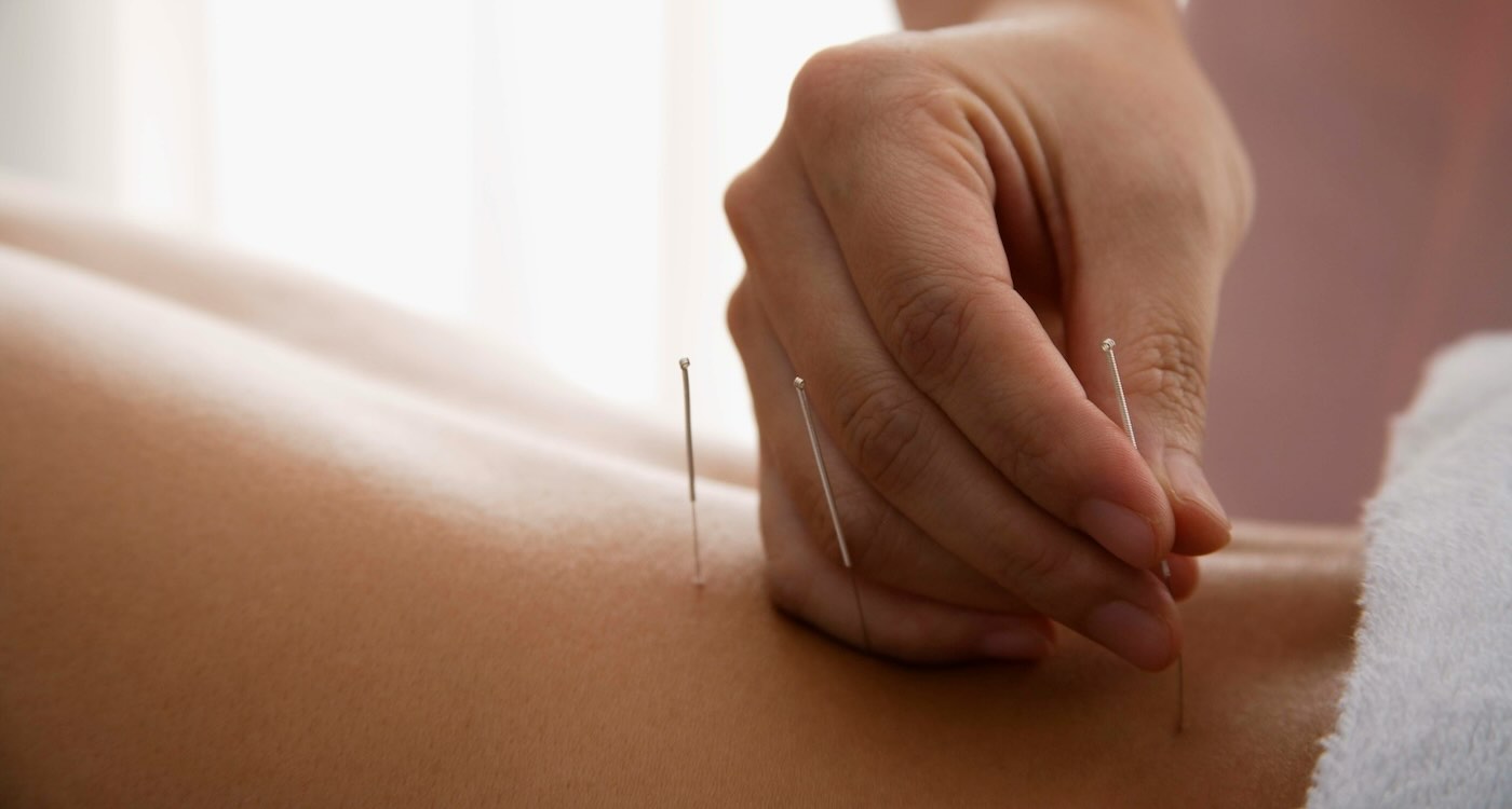 Acupuncture is an Effective Treatment for Back Pain in SeniorsโAnd Sometimes it’s Covered by U.S. Medicare