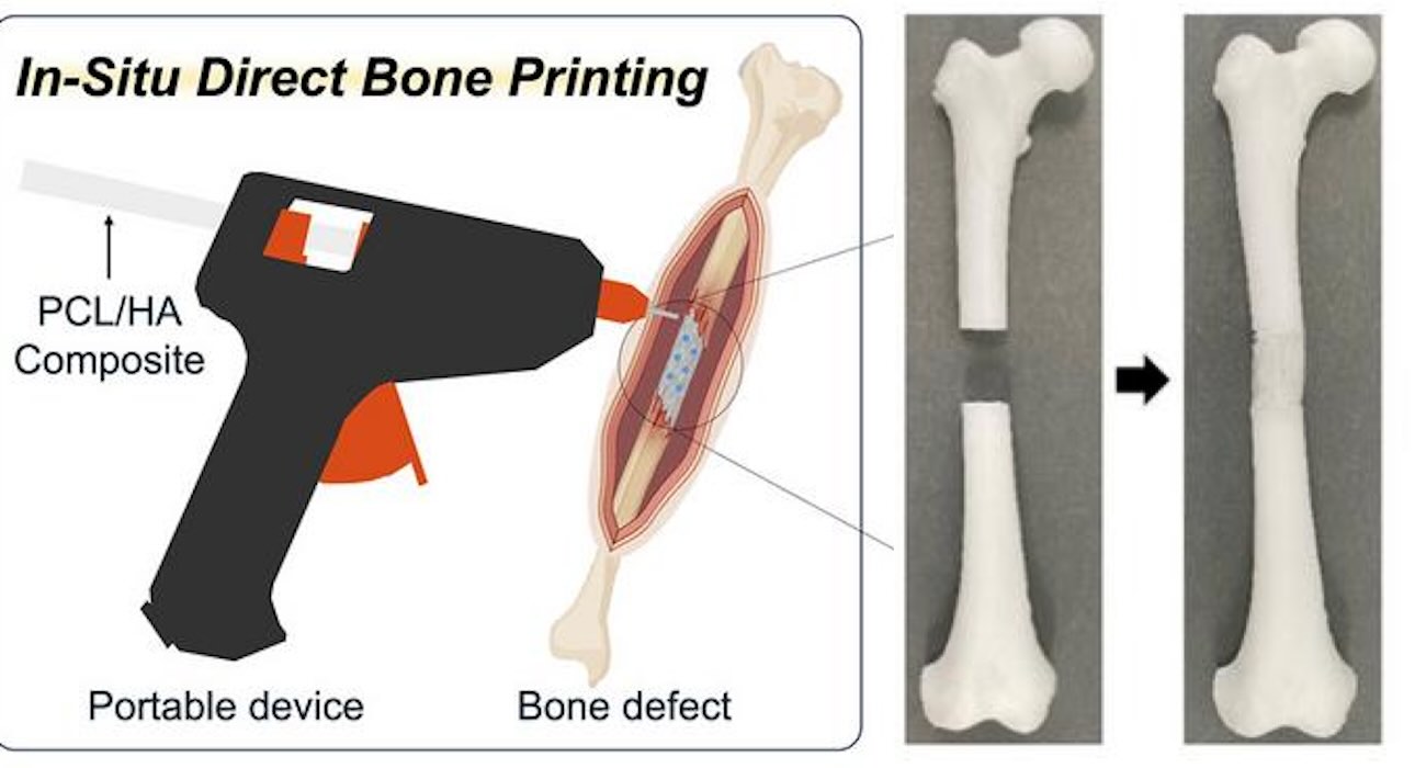 3D-Printing โGlue Gunโ Can Repair Bone Fractures During Surgery Filling-in the Gaps Around Jagged Edges