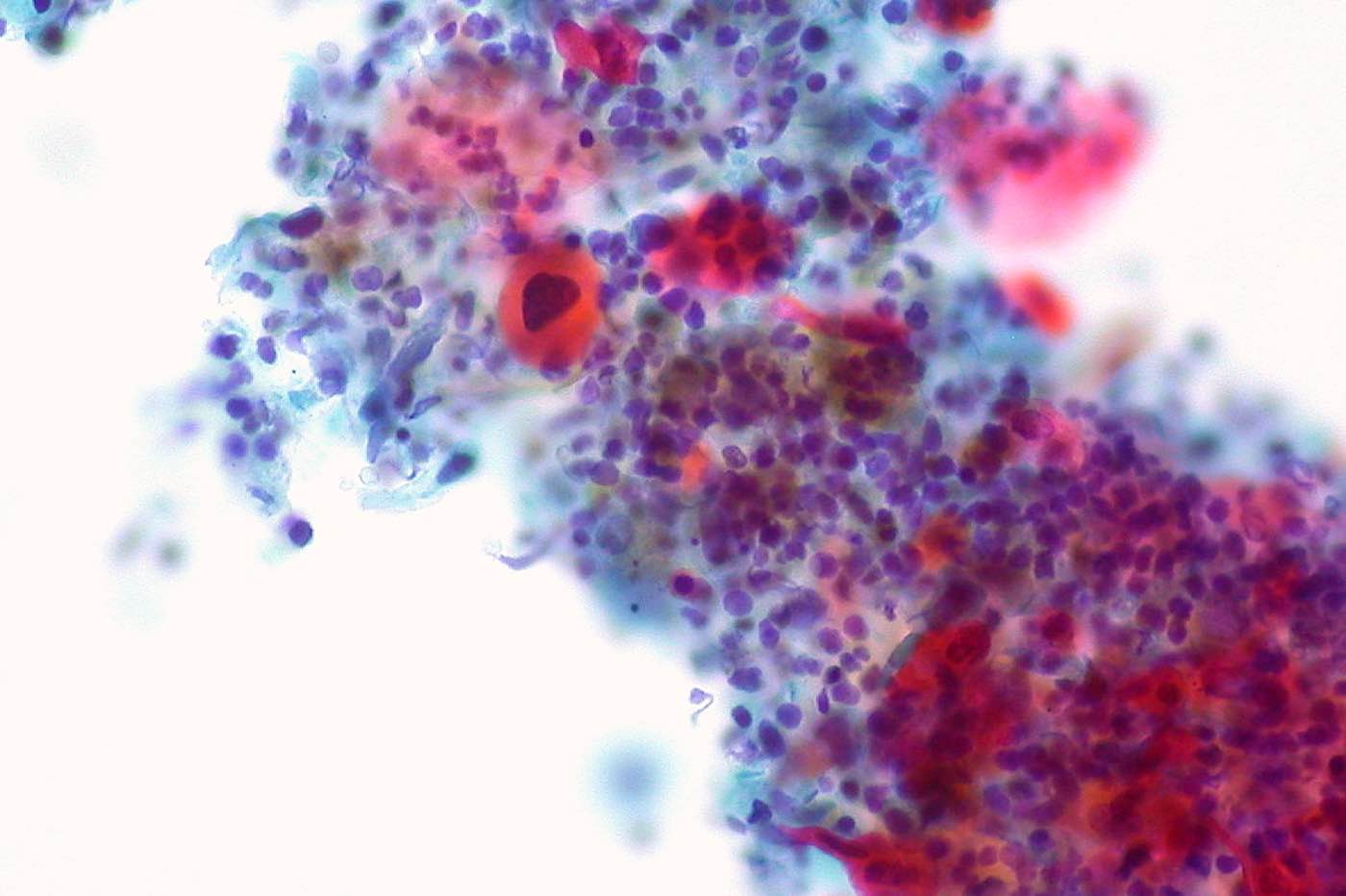 โIncredibly Encouragingโ Drug Trial Shrinks Tumors in Head and Neck Cancer Patients Within Six Weeks