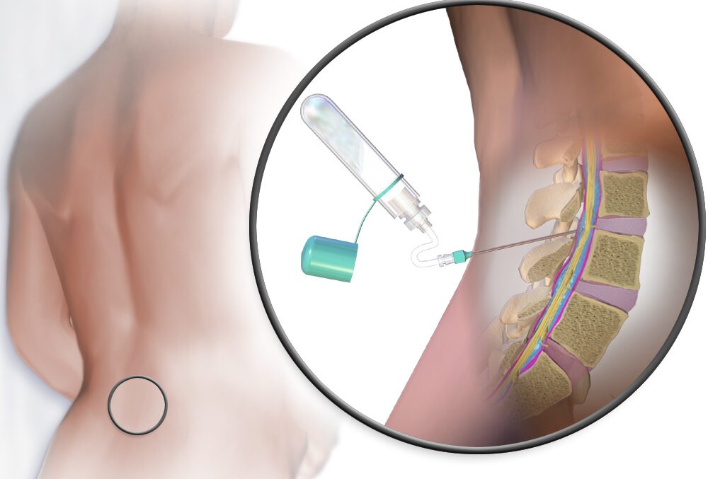 Patients Thought Untreatable with Rare Disease Dramatically Improve with Common Gene Therapy